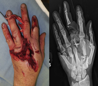 Hand Surgery