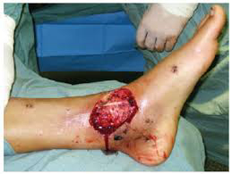 Wound Care